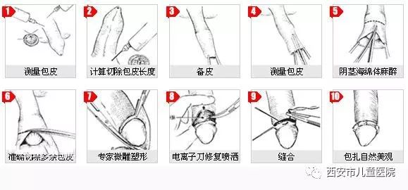 最新割包皮技术，现代医疗进步与创新探索