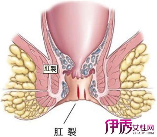 最新肛裂治疗方法的研究与应用及其疗效评估